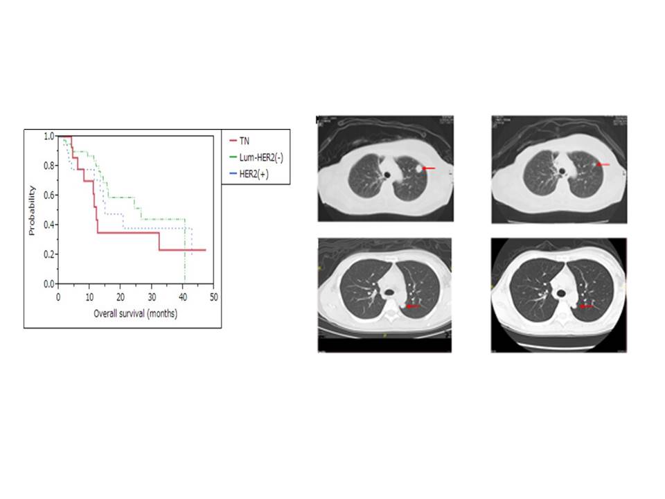 mammary_cancer2