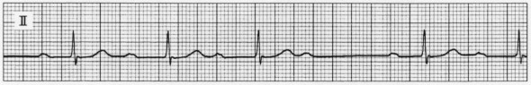 ECG